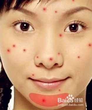 怎样消除青春痘和粉刺最快的方式,如何有效祛除青春痘