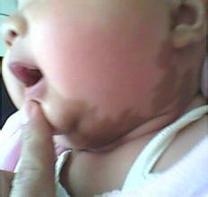 胎记、血管瘤治疗方式很重要！