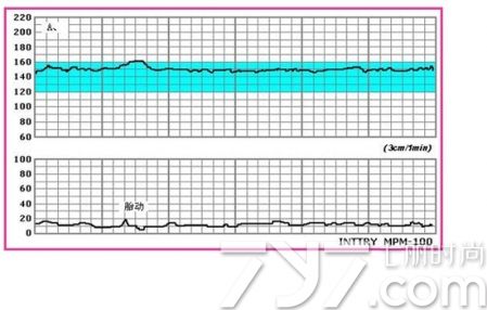 胎心监护评分怎么看显示屏,合格的胎心监护图是怎么样的