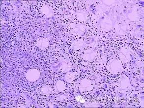 伍德灯检查淡蓝色荧光,伍德灯检查褐色荧光