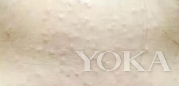 去闭口美容项目,美容护肤问题解答