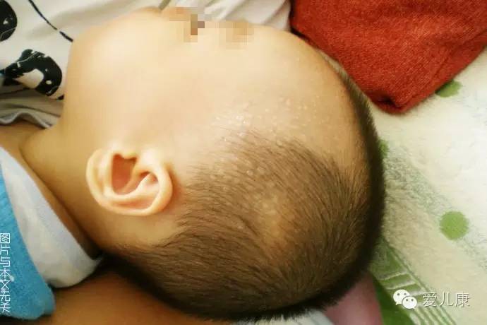 有些家长认为宝宝爱出汗就是体虚,儿科医生小宝宝老是出汗