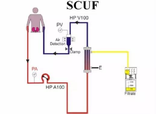 连续性血液净化设备,连续性血液净化技术操作视频