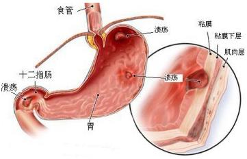 结肠炎正确饮食方法,结肠炎怎么治才好得快