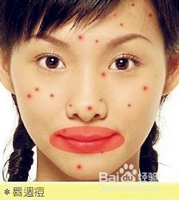 怎样消除青春痘和粉刺最快的方式,如何有效祛除青春痘