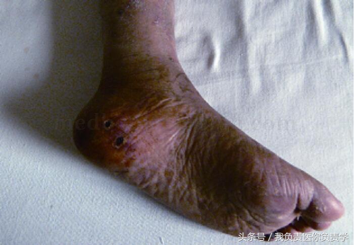 肾移植后坏死能活多久,肾移植后常见的感染部位有哪些