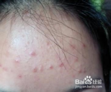 怎样消除青春痘和粉刺最快的方式,如何有效祛除青春痘