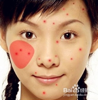 怎样消除青春痘和粉刺最快的方式,如何有效祛除青春痘