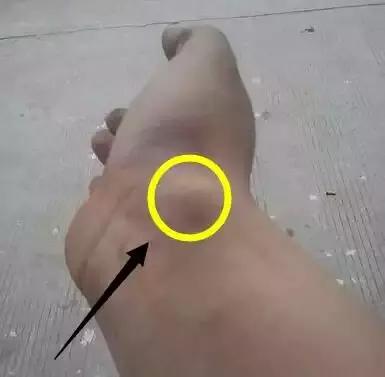 手腕腱鞘炎的艾灸疗法,手腕腱鞘炎艾灸哪个穴位