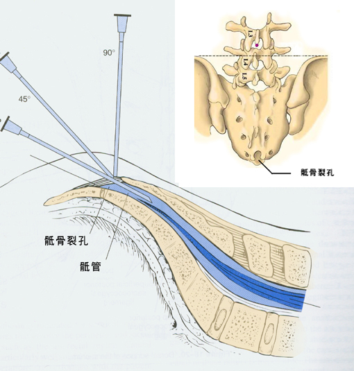 高龄老年腰腿痛患者可以尝试的一种无创疗法