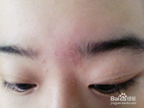 怎样消除青春痘和粉刺最快的方式,如何有效祛除青春痘