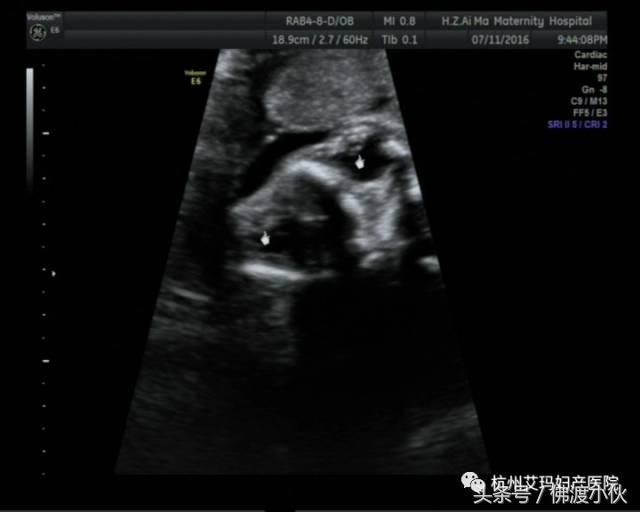 “借我，借我一双慧眼吧”——胎儿眼畸形
