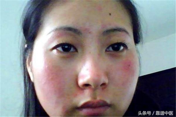 脸过敏发红发痒怎么护肤,脸过敏发痒发红怎么消除