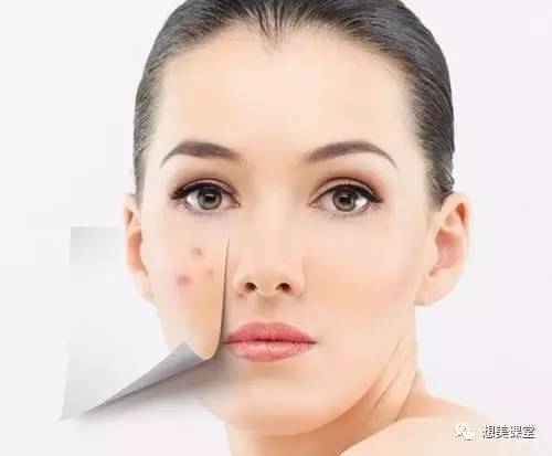 皮肤长痘不容易好,皮肤油长痘怎么解决
