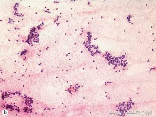 卵巢肿瘤穿刺活检结果,卵巢囊肿穿刺从哪穿刺