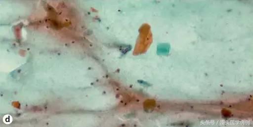 卵巢肿瘤穿刺活检结果,卵巢囊肿穿刺从哪穿刺