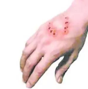 怎么分辨狗咬了要不要打针,被宠物狗咬多久打针