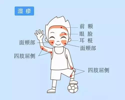 小儿湿疹一般医生开什么药,小儿湿疹护理的文章