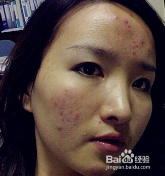 怎样消除青春痘和粉刺最快的方式,如何有效祛除青春痘