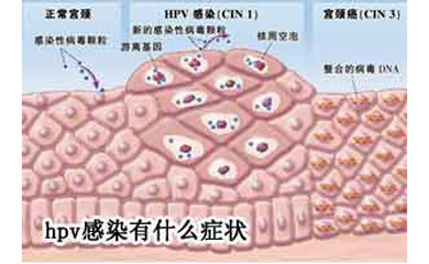 尖锐湿疣，中医内外合治有3个原则