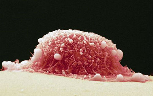 尖锐湿疣，中医内外合治有3个原则