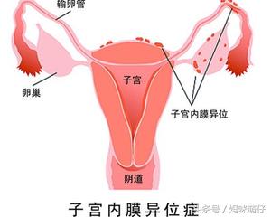 备孕痛经吃依托考昔,备孕痛经要不要去中医调理