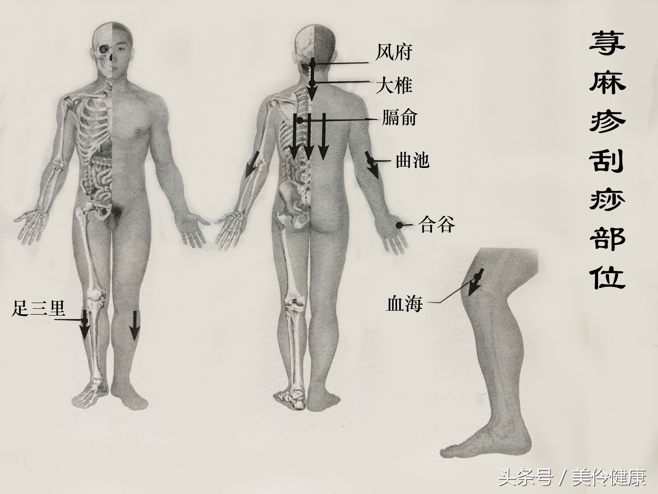 白癜风治疗的刮痧法,刮痧刺血治疗白癜风