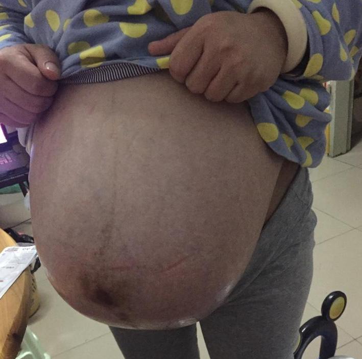 孕38周+2天超快顺产女宝一枚，（无侧切）附上四维和数据症状