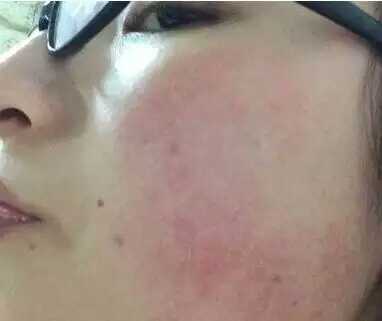 全身皮肤干燥缺水怎么补水,冬天肌肤干燥缺水怎么办