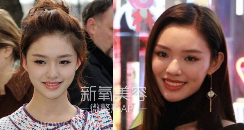 林允整牙却像整容？她是真的又整了啊！