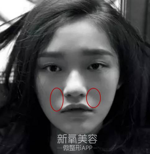 林允整牙却像整容？她是真的又整了啊！