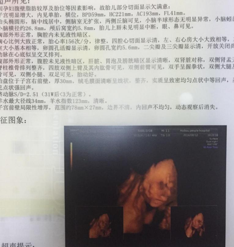 孕38周+2天超快顺产女宝一枚，（无侧切）附上四维和数据症状