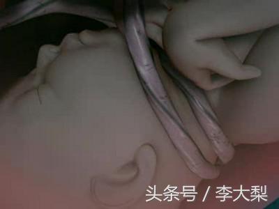 胎儿脐带绕颈怎么缓解,胎儿脐带绕颈最佳治疗方法