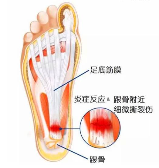 足底筋膜炎康复训练,脚筋膜炎运动康复训练