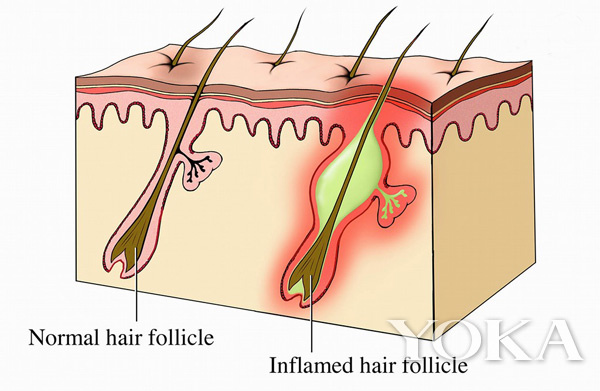 去闭口美容项目,美容护肤问题解答