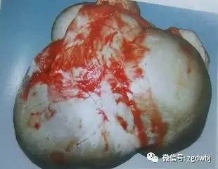 羊瘤胃积食打针后多久治愈,羊瘤胃积食的治疗视频