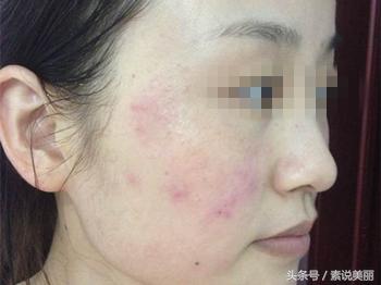 如果脸上涂了激素产品后果怎么样,脸上用了含激素的产品应该怎么办