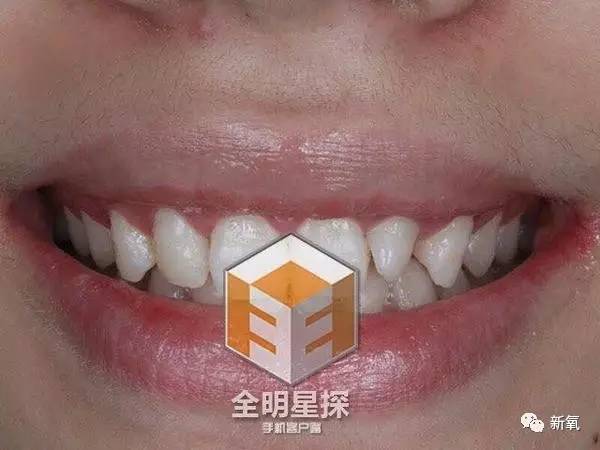 林允整牙却像整容？她是真的又整了啊！