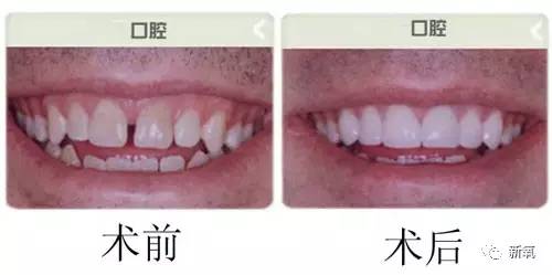 林允整牙却像整容？她是真的又整了啊！