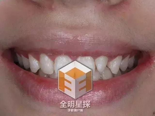 林允的牙怎么又恢复了,林允回应脸型变化她又变脸了吗