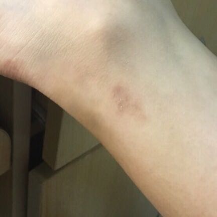 推荐便宜好用的祛疤膏,你有什么祛疤膏推荐吗