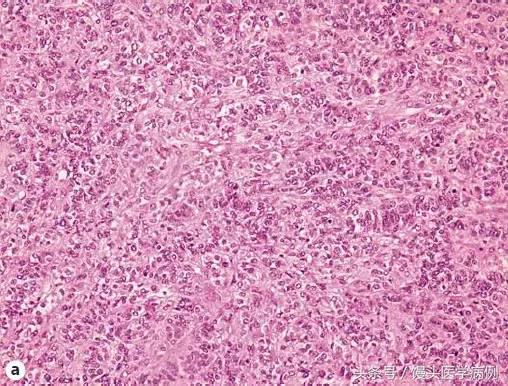 卵巢肿瘤穿刺活检结果,卵巢囊肿穿刺从哪穿刺