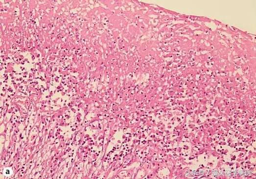 卵巢肿瘤穿刺活检结果,卵巢囊肿穿刺从哪穿刺