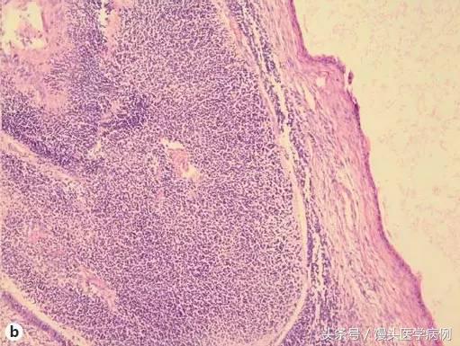 卵巢肿瘤穿刺活检结果,卵巢囊肿穿刺从哪穿刺
