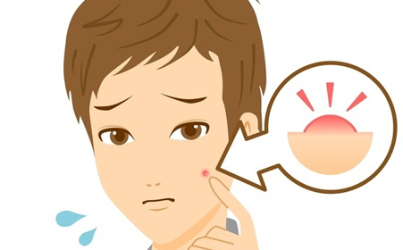 青春痘药过敏怎么办,用了祛痘的药脸发红