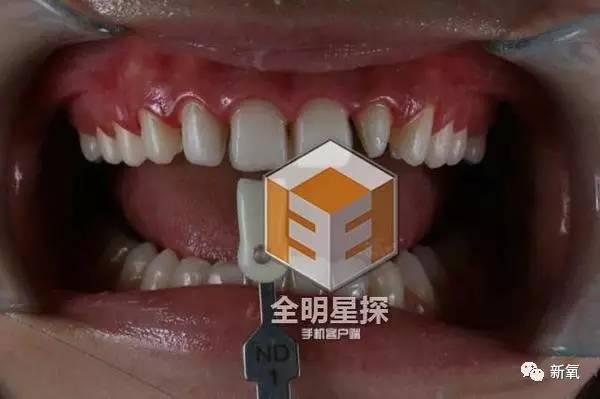 林允整牙却像整容？她是真的又整了啊！