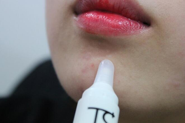 右脸长痘怎么快速有效的解决,婴儿右脸长痘痘是什么原因