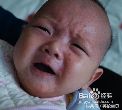 宝宝湿疹妈妈的心酸,宝妈湿疹的亲身经历
