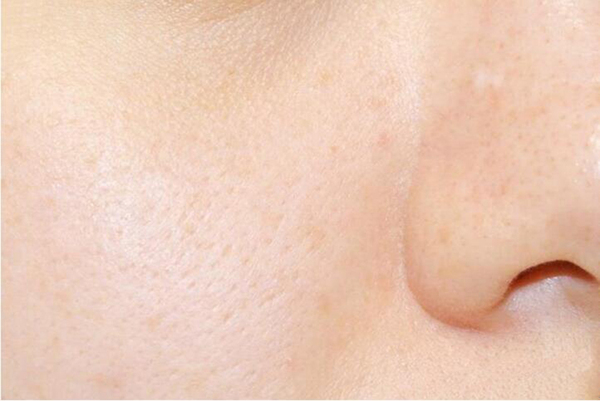 右脸颊长痘的原因及调理方法_治疗痘痘很简单