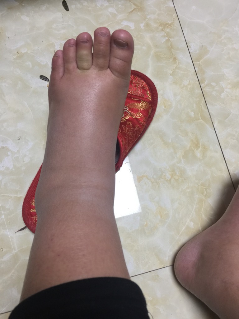 一个月水肿怎么消除小妙招,准妈咪如何远离水肿困扰